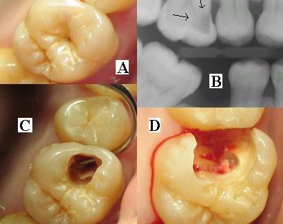 Worried About Decay In Your Tooth? ( Karies im Zahn ) Worried About Decay In Your Tooth? ( Karies im Zahn )