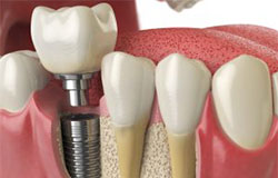 Bone substitute material Bone substitute material