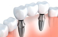 Implantat – Garantía Implantat – Garantía