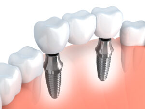 Mehr über den Artikel erfahren Implantat – Garantie