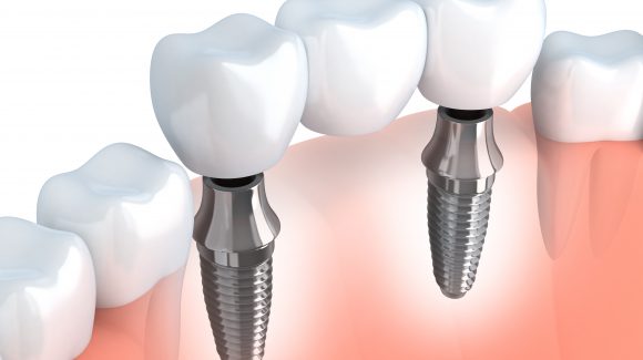 Implantat – Garantie Implantat – Garantie