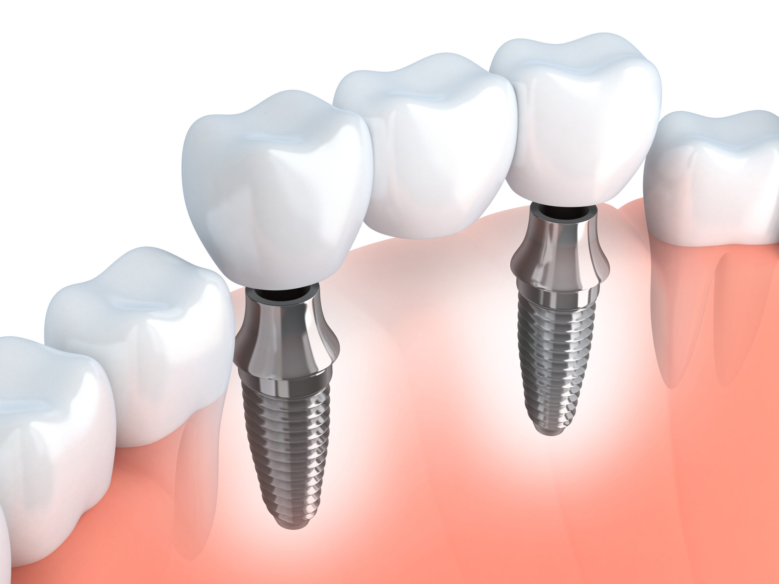 Du betrachtest gerade Implantat – Garantie