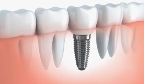 die Bedeutung von Zahnimplantate