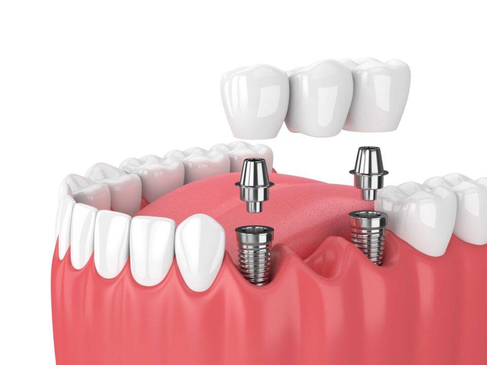 Dental-Implant